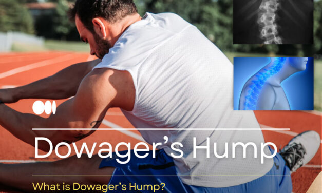 Dowager’s Hump: Symptoms, Cure, and Prevention